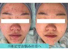 リメイクビューティークリニック(REMAKE BEAUTY CLINIC)/本気のニキビケア