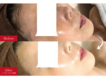 メロー(MELLOW)/ハーブピーリング(くすみ)