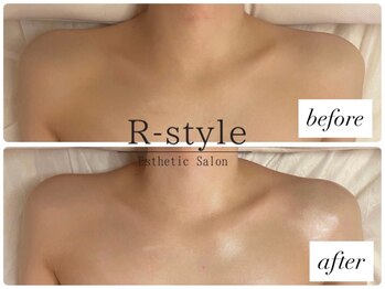 エステサロン アールスタイル(R-style)/デコルテビフォーアフター写真