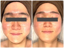 ノア(NOA.)の雰囲気（MEN'Sエステ歓迎★たるみケア“高周波サーマルショット”解禁）