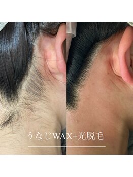 ディア(Dea)/襟足・うなじ WAX脱毛