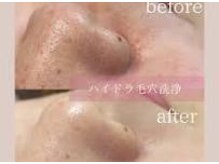 ウェルビーイング(well-being)/毛穴の開き黒ずみ対策