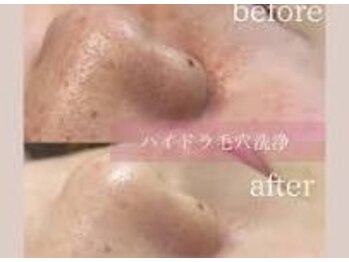 ウェルビーイング(well-being)/毛穴の開き黒ずみ対策