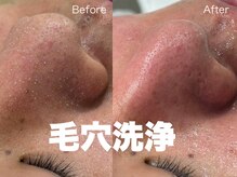 オンリィケア 関大前店(ONLY CARE)の雰囲気（【Bubble毛穴洗浄】毛穴ケアならお任せください。ホームケアも◎）
