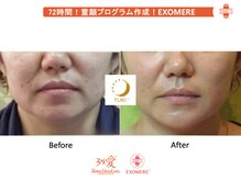 ツキ(TUKI+)/剥けない・ダウンタイム無し