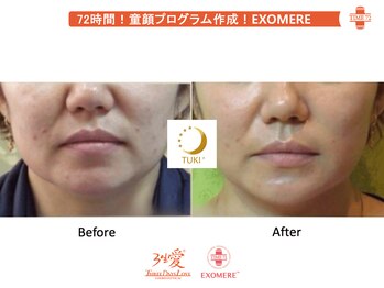 ツキ(TUKI+)/剥けない・ダウンタイム無し