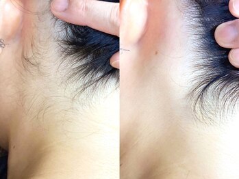 アース コアフュールボーテ 新潟中野山店 (EARTH Coiffure beaute')の写真/スピーディー!脱毛メニュー導入★忘れがちな産毛～気になる太い毛まで徹底脱毛!キメの整った美肌に◎
