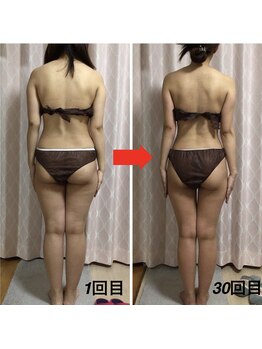 トロイカ 天王寺店(troika)/全身メディセル30回/30代前半