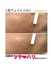 ココネイル 板山店(coco nail)/人気No.1連射式＊光フェイシャル