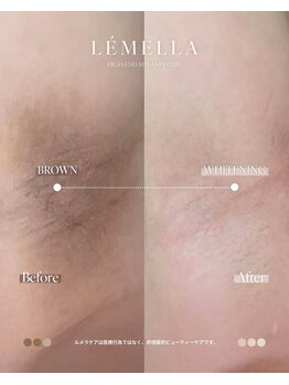 チョアビューティー(choa beauty)/ルメラ韓国式メラニンケア【ワキ