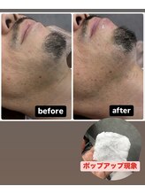 ココプラス(COCO+)/男性ヒゲ脱毛