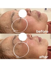 エアリアル 八女店/目元の深いシワも改善！！