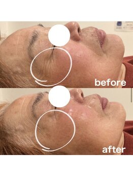 エアリアル 八女店/目元の深いシワも改善!!