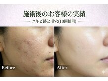 ワイズデュー(Y's Dew)/ハーブピーリング剥離なし