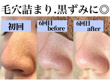 アンドピエル(AndPiel)/毛穴詰まり、黒ずみに◎