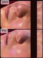 ヴィズコレクトビューティ(VIZ CORRECT BEAUTY)/毛穴洗浄2