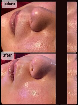 ヴィズコレクトビューティ(VIZ CORRECT BEAUTY)/毛穴洗浄2