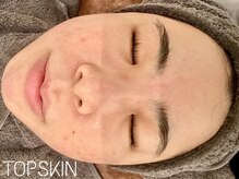 トップスキン 表参道(TOPSKIN)/TOPSKIN限定☆専門家開発TCLINE
