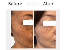 アブニールブリヨン/ハーブピーリング　Before After