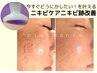 【ご新規様】ニキビでお悩みの方に！毛穴凹凸ケアプラズマニア