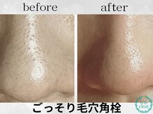 リエラ(Liella)/毛穴エクストラクション