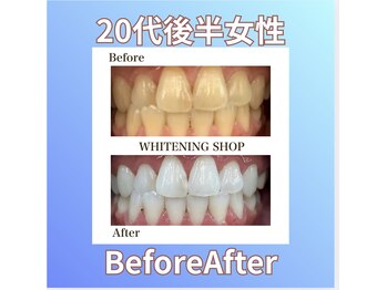 ホワイトニングショップ 西原店/20代後半女性☆BeforeAfter
