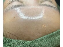 サイ(Sai)/SMOREピーリング