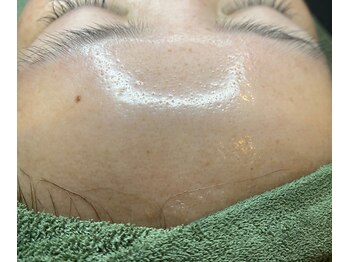 サイ(Sai)/SMOREピーリング