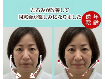 ピュアハリ/沖縄美容鍼 効果