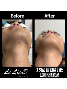 ルリアン(Le Lien)/【メンズ】ヒゲ症例