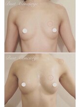 ソラ(sora)/バストアップ・バストケア症例★