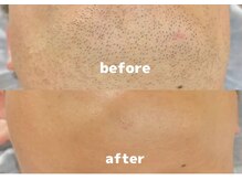 ハルコウ(HALKOU)の雰囲気（ひげのビフォーアフターです^ ^）