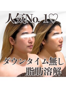 ミタメ 銀座店(MITAME)/ダウンタイムのない脂肪燃解◎
