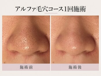 トリプルサンショップ 京都店の写真/【京都/四条】大人の毛穴悩みに。黒ずみ・角栓・ザラつきを丁寧に洗浄し、つるんとなめらかな素肌へ
