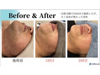 精神と時の部屋/髭の濃い方にこそ、LED脱毛です