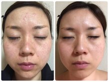 ビューティーモア(more)/ニキビケアも★ハーブピーリング