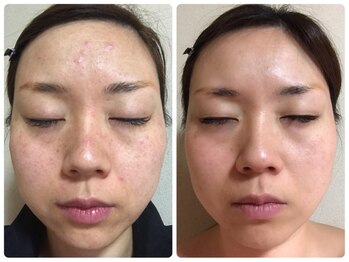 ビューティーモア(more)/ニキビケアも★ハーブピーリング