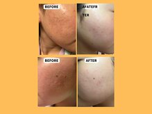 ウルーズ(HRUREUSE)/ニキビも体質から整える