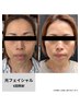 【短時間で効果◎】リフトアップ・シワ改善フェイシャル ￥6.000→￥5.000