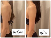 エステサロン アールスタイル(R-style)/巻き肩改善ビフォーアフター写真