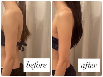 エステサロン アールスタイル(R-style)/巻き肩改善ビフォーアフター写真