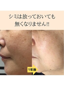 パルサロン(palsalon.)/パルサロン　シミケア