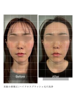 ルフレ 心斎橋(Reflet)/小顔矯正&毛穴洗浄 BeforeAfter