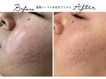 アリュール 倉敷(ALLURE)の写真/最強肌質改善メニュー◇すぐ効果を実感!お好みの肌質改善メニュー＋水光ボツリヌスの組み合わせで効果絶大