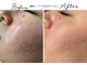 アリュール 倉敷(ALLURE)の写真/最強肌質改善メニュー◇すぐ効果を実感!お好みの肌質改善メニュー＋水光ボツリヌスの組み合わせで効果絶大