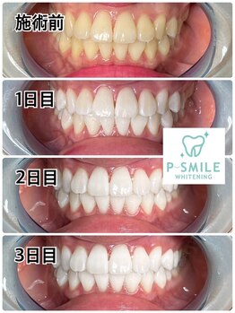 ホワイトベース(White Base)/お客様の施術後