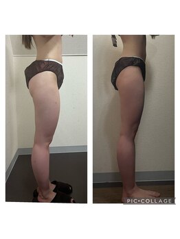 サロンドココ(Salon de COCO)/ハイパーナイフ痩身