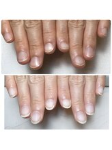 スマイルニコ(smile nico)/深爪矯正メンテナンス