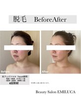 エミルカ(EMILUCA)/光フェイシャル