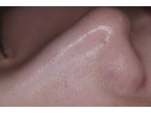 岩川治療院/毛穴の汚れをしっかり除去